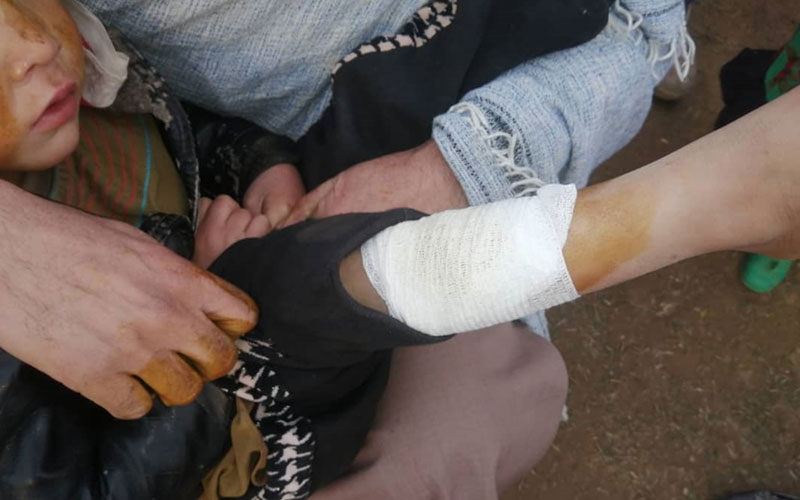 An adult helps a child with a bandaged leg.