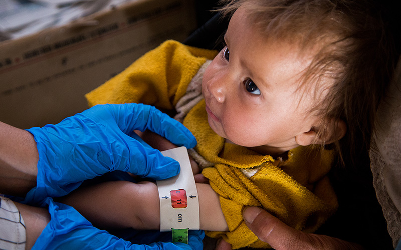 A young child is checked out at a World Vision Mobile Health Clinic. The band around the child’s arm measures ‘red’ for danger.